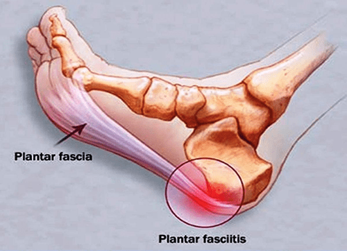 Hielspoor - fasciitis plantaris